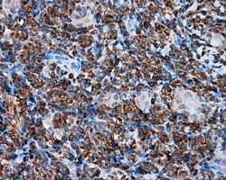 TPMT Antibody - IHC of paraffin-embedded Carcinoma of thyroid tissue using anti-TPMT mouse monoclonal antibody. (Dilution 1:50).