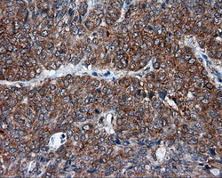 TPMT Antibody - IHC of paraffin-embedded Adenocarcinoma of endometrium tissue using anti-TPMT mouse monoclonal antibody. (Dilution 1:50).