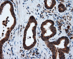 TPMT Antibody - IHC of paraffin-embedded Carcinoma of prostate tissue using anti-TPMT mouse monoclonal antibody. (Dilution 1:50).