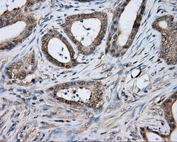 TPMT Antibody - IHC of paraffin-embedded Adenocarcinoma of colon tissue using anti-TPMT mouse monoclonal antibody. (Dilution 1:50).