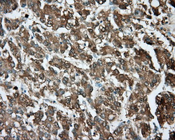 TPMT Antibody - IHC of paraffin-embedded Carcinoma of liver tissue using anti-TPMT mouse monoclonal antibody. (Dilution 1:50).