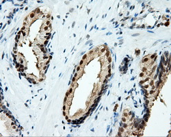 TPMT Antibody - IHC of paraffin-embedded Carcinoma of prostate tissue using anti-TPMT mouse monoclonal antibody. (Dilution 1:50).