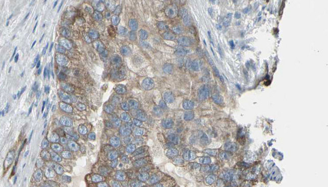 TPMT Antibody - 1:100 staining human prostate tissue by IHC-P. The sample was formaldehyde fixed and a heat mediated antigen retrieval step in citrate buffer was performed. The sample was then blocked and incubated with the antibody for 1.5 hours at 22°C. An HRP conjugated goat anti-rabbit antibody was used as the secondary.