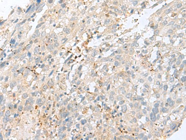 TPMT Antibody - Immunohistochemistry of paraffin-embedded Human cervical cancer tissue  using TPMT Polyclonal Antibody at dilution of 1:60(×200)