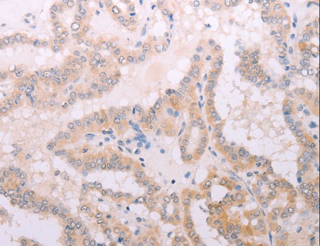 TPO / Thyroid Peroxidase Antibody - Immunohistochemistry of paraffin-embedded Human thyroid cancer using TPO Polyclonal Antibody at dilution of 1:50.