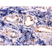 TPP1 / CLN2 Antibody - TPP1 was detected in paraffin-embedded sections of human lung cancer tissues using rabbit anti- TPP1 Antigen Affinity purified polyclonal antibody at 1 ug/mL. The immunohistochemical section was developed using SABC method.