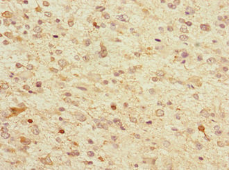 TPPP Antibody - Immunohistochemistry of paraffin-embedded human glioma at dilution 1:100