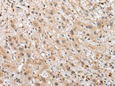 TPPP Antibody - Immunohistochemistry of paraffin-embedded Human liver cancer tissue  using TPPP Polyclonal Antibody at dilution of 1:25(×200)