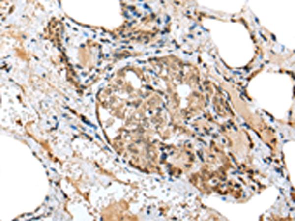 TPPP Antibody - Immunohistochemistry of paraffin-embedded Human thyroid cancer tissue  using TPPP Polyclonal Antibody at dilution of 1:25(×200)