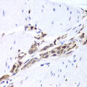 TPPP3 Antibody - Immunohistochemistry of paraffin-embedded human gastric cancer tissue.