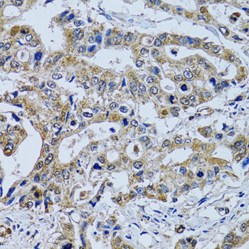 TPPP3 Antibody - Immunohistochemistry of paraffin-embedded human colon carcinoma tissue.