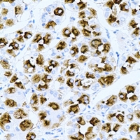 TPPP3 Antibody - Immunohistochemical analysis of TPPP3 staining in human gastric cancer formalin fixed paraffin embedded tissue section. The section was pre-treated using heat mediated antigen retrieval with sodium citrate buffer (pH 6.0). The section was then incubated with the antibody at room temperature and detected using an HRP conjugated compact polymer system. DAB was used as the chromogen. The section was then counterstained with hematoxylin and mounted with DPX.