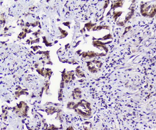 TPR Antibody - IHC analysis of TPR using anti-TPR antibody. TPR was detected in paraffin-embedded section of human lung cancer tissues. Heat mediated antigen retrieval was performed in citrate buffer (pH6, epitope retrieval solution) for 20 mins. The tissue section was blocked with 10% goat serum. The tissue section was then incubated with 1µg/ml rabbit anti-TPR Antibody overnight at 4°C. Biotinylated goat anti-rabbit IgG was used as secondary antibody and incubated for 30 minutes at 37°C. The tissue section was developed using Strepavidin-Biotin-Complex (SABC) with DAB as the chromogen.