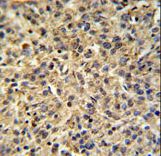 TPRG1L Antibody - TPRGL Antibody IHC of formalin-fixed and paraffin-embedded human cervix carcinoma tissue followed by peroxidase-conjugated secondary antibody and DAB staining.