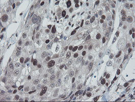 TPRKB Antibody - IHC of paraffin-embedded Adenocarcinoma of Human breast tissue using anti-TPRKB mouse monoclonal antibody. (Heat-induced epitope retrieval by 10mM citric buffer, pH6.0, 100C for 10min).