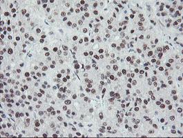 TPRKB Antibody - IHC of paraffin-embedded Carcinoma of Human liver tissue using anti-TPRKB mouse monoclonal antibody. (Heat-induced epitope retrieval by 10mM citric buffer, pH6.0, 100C for 10min).