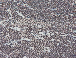TPRKB Antibody - IHC of paraffin-embedded Human lymphoma tissue using anti-TPRKB mouse monoclonal antibody. (Heat-induced epitope retrieval by 10mM citric buffer, pH6.0, 100C for 10min).