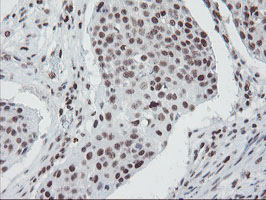 TPRKB Antibody - IHC of paraffin-embedded Carcinoma of Human lung tissue using anti-TPRKB mouse monoclonal antibody.