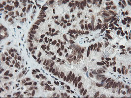 TPRKB Antibody - IHC of paraffin-embedded Adenocarcinoma of Human ovary tissue using anti-TPRKB mouse monoclonal antibody.