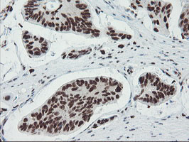 TPRKB Antibody - IHC of paraffin-embedded Carcinoma of Human pancreas tissue using anti-TPRKB mouse monoclonal antibody.