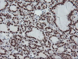 TPRKB Antibody - IHC of paraffin-embedded Carcinoma of Human thyroid tissue using anti-TPRKB mouse monoclonal antibody.
