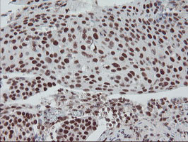 TPRKB Antibody - IHC of paraffin-embedded Carcinoma of Human bladder tissue using anti-TPRKB mouse monoclonal antibody.