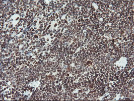 TPRKB Antibody - IHC of paraffin-embedded Human lymphoma tissue using anti-TPRKB mouse monoclonal antibody.