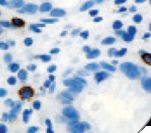 TPSAB1 / Mast Cell Tryptase Antibody - IHC of Tryptase on FFPE H. pylori Infected Stomach tissue. This image was taken for the unmodified form of this product. Other forms have not been tested.