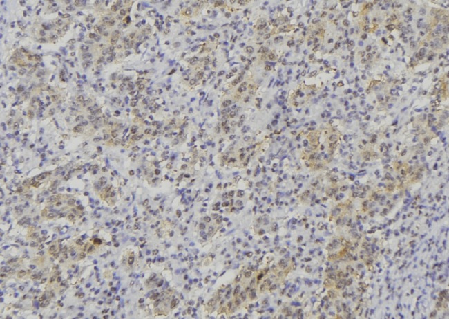 TPSAB1 / Mast Cell Tryptase Antibody - 1:100 staining human lung carcinoma tissue by IHC-P. The sample was formaldehyde fixed and a heat mediated antigen retrieval step in citrate buffer was performed. The sample was then blocked and incubated with the antibody for 1.5 hours at 22°C. An HRP conjugated goat anti-rabbit antibody was used as the secondary.