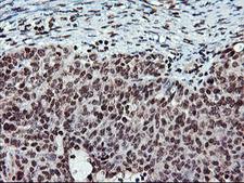 TPSG1 / Tryptase Gamma 1 Antibody - IHC of paraffin-embedded Adenocarcinoma of Human ovary tissue using anti-TPSG1 mouse monoclonal antibody. (Heat-induced epitope retrieval by 10mM citric buffer, pH6.0, 100C for 10min).