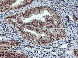 TPSG1 / Tryptase Gamma 1 Antibody - IHC of paraffin-embedded Adenocarcinoma of Human endometrium tissue using anti-TPSG1 mouse monoclonal antibody. (Heat-induced epitope retrieval by 10mM citric buffer, pH6.0, 100C for 10min).