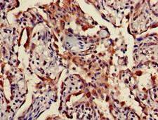 TPST1 Antibody - Immunohistochemistry of paraffin-embedded human lung cancer using TPST1 Antibody at dilution of 1:100