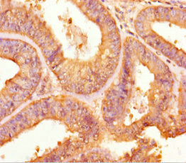 TPST2 Antibody - Immunohistochemistry of paraffin-embedded human endometrial cancer using TPST2 Antibody at dilution of 1:100