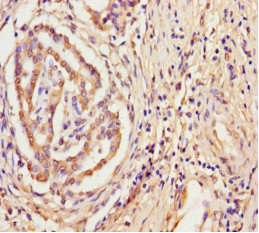 TPST2 Antibody - Immunohistochemistry of paraffin-embedded human pancreatic cancer using TPST2 Antibody at dilution of 1:100