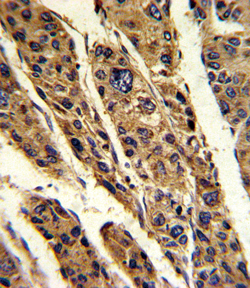 TPT1 / TCTP Antibody - Formalin-fixed and paraffin-embedded human hepatocarcinoma reacted with TPT1 Antibody , which was peroxidase-conjugated to the secondary antibody, followed by DAB staining. This data demonstrates the use of this antibody for immunohistochemistry; clinical relevance has not been evaluated.
