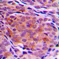 TPT1 / TCTP Antibody - Immunohistochemical analysis of TCTP staining in human breast cancer formalin fixed paraffin embedded tissue section. The section was pre-treated using heat mediated antigen retrieval with sodium citrate buffer (pH 6.0). The section was then incubated with the antibody at room temperature and detected using an HRP conjugated compact polymer system. DAB was used as the chromogen. The section was then counterstained with hematoxylin and mounted with DPX.