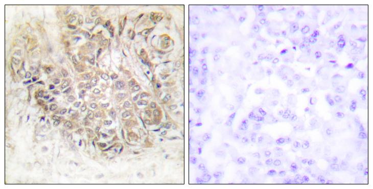 TPT1 / TCTP Antibody - Peptide - + Immunohistochemistry analysis of paraffin-embedded human breast carcinoma tissue using TCTP antibody.