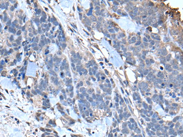 TPT1 / TCTP Antibody - Immunohistochemistry of paraffin-embedded Human thyroid cancer tissue  using TPT1 Polyclonal Antibody at dilution of 1:85(×200)