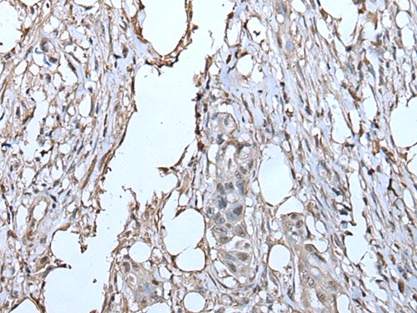TPT1 / TCTP Antibody - Immunohistochemistry of paraffin-embedded Human colorectal cancer tissue  using TPT1 Polyclonal Antibody at dilution of 1:85(×200)