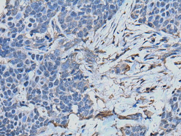 TPT1 / TCTP Antibody - Immunohistochemistry of paraffin-embedded Human thyroid cancer tissue  using TPT1 Polyclonal Antibody at dilution of 1:45(×200)
