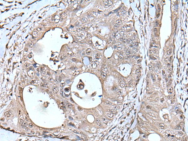 TPT1 / TCTP Antibody - Immunohistochemistry of paraffin-embedded Human colorectal cancer tissue  using TPT1 Polyclonal Antibody at dilution of 1:45(×200)