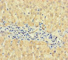 TPTE2 Antibody - Immunohistochemistry of paraffin-embedded human liver cancer using TPTE2 Antibody at dilution of 1:100