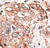 TPX2 Antibody - Formalin-fixed and paraffin-embedded human cancer tissue reacted with the primary antibody, which was peroxidase-conjugated to the secondary antibody, followed by DAB staining. This data demonstrates the use of this antibody for immunohistochemistry; clinical relevance has not been evaluated. BC = breast carcinoma; HC = hepatocarcinoma.