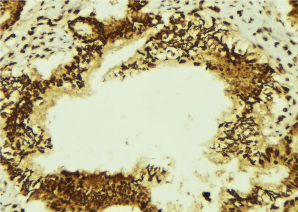 TRA2A Antibody - 1:100 staining human breast carcinoma tissue by IHC-P. The sample was formaldehyde fixed and a heat mediated antigen retrieval step in citrate buffer was performed. The sample was then blocked and incubated with the antibody for 1.5 hours at 22°C. An HRP conjugated goat anti-rabbit antibody was used as the secondary.