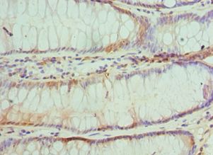 TRADD Antibody - Immunohistochemistry of paraffin-embedded human colon cancer using antibody at 1:100 dilution.