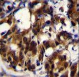 TRADD Antibody - TRADD Antibody immunohistochemistry of formalin-fixed and paraffin-embedded human breast carcinoma followed by peroxidase-conjugated secondary antibody and DAB staining.