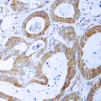 TRADD Antibody - Immunohistochemical analysis of TRADD staining in human colon cancer formalin fixed paraffin embedded tissue section. The section was pre-treated using heat mediated antigen retrieval with sodium citrate buffer (pH 6.0). The section was then incubated with the antibody at room temperature and detected using an HRP-conjugated compact polymer system. DAB was used as the chromogen. The section was then counterstained with hematoxylin and mounted with DPX.