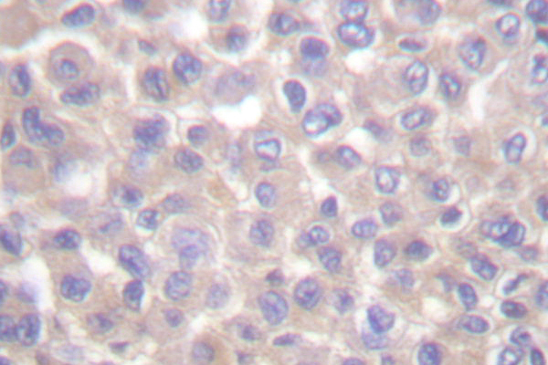 TRADD Antibody - IHC of TRADD (L282) pAb in paraffin-embedded human breast carcinoma tissue.
