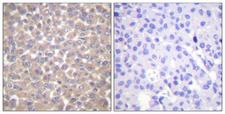 TRADD Antibody - Peptide - + Immunohistochemistry analysis of paraffin-embedded human breast carcinoma tissue using TRADD antibody.