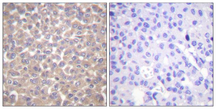 TRADD Antibody - Peptide - + Immunohistochemistry analysis of paraffin-embedded human breast carcinoma tissue using TRADD antibody.